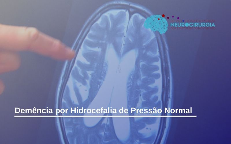 Conhe A A Dem Ncia Por Hidrocefalia De Press O Normal