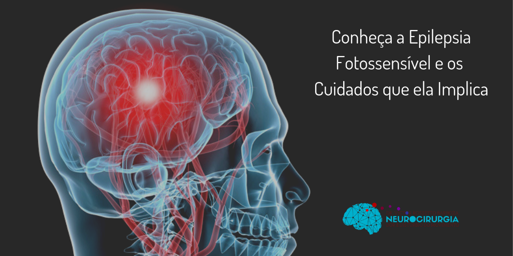 Conheça a Epilepsia Fotossensível e seus Cuidados | Dr. Victor Barboza